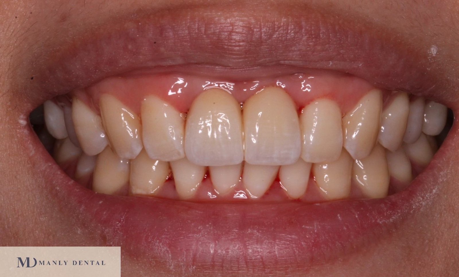 after dental implant