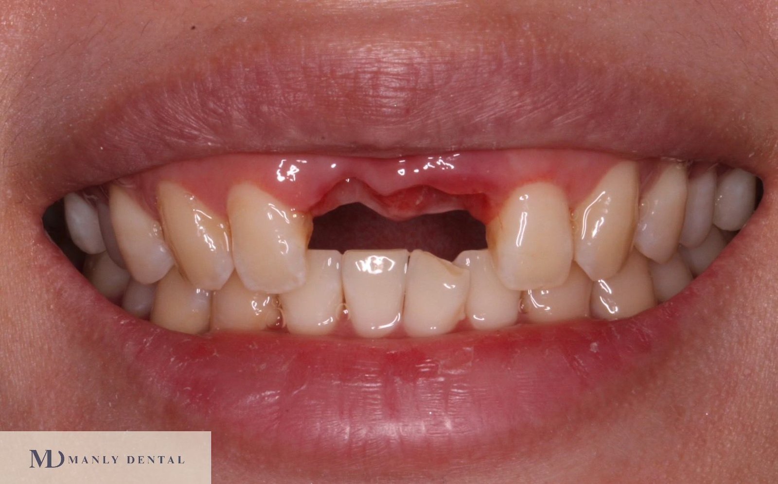 before dental implant